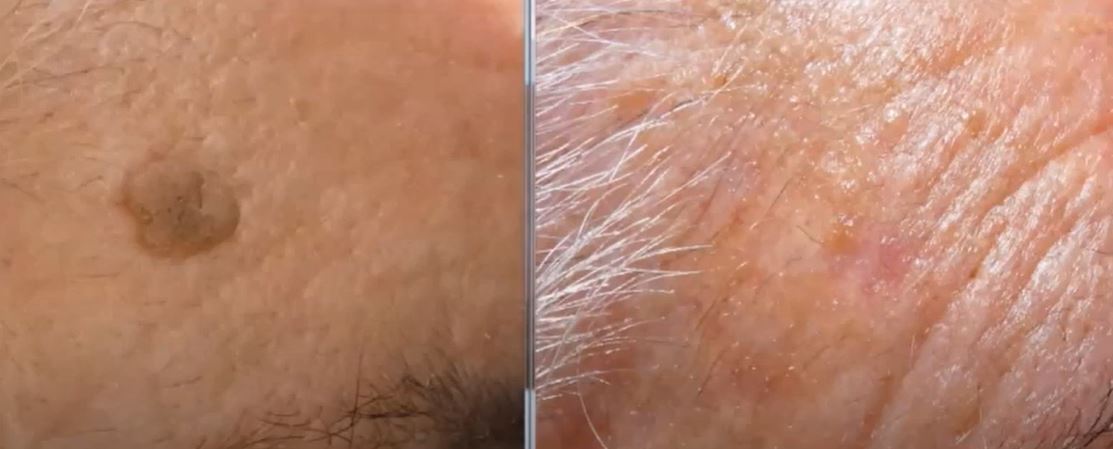Dermoestética con Láser CO2